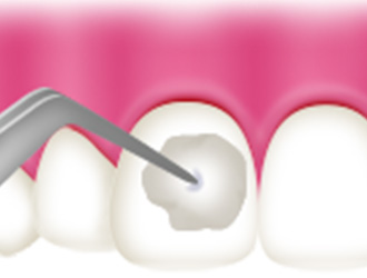 フッ素塗布 さくら 南草津の歯医者
