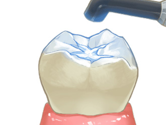シーラント さくら 南草津の歯医者