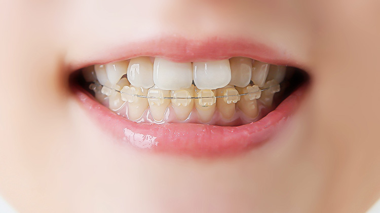 小児矯正と成人矯正、それぞれのメリット さくら 南草津の歯医者