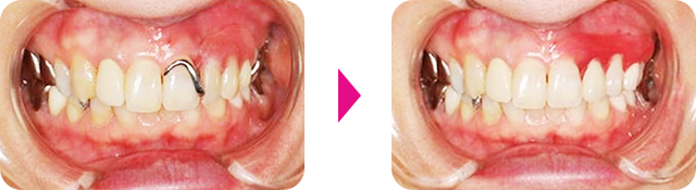 「ノンクラスプデンチャー」 さくら 南草津の歯医者