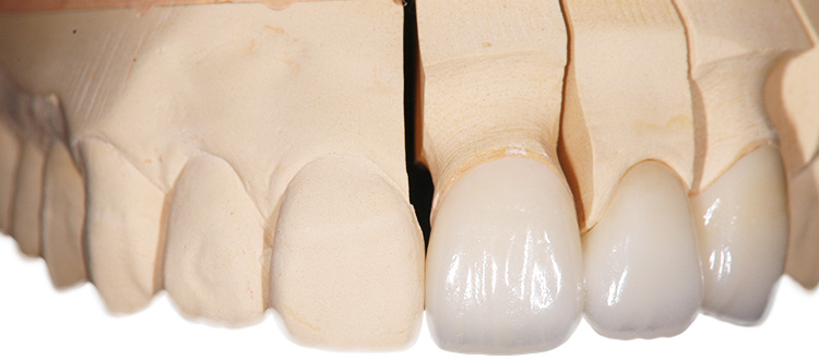 ジルコニア さくら 南草津の歯医者